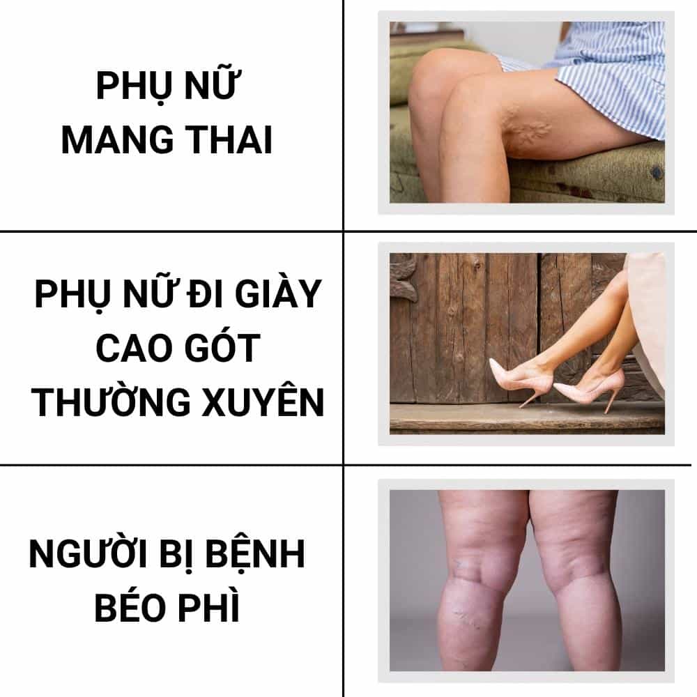 Suy tĩnh mạch là gì? 2 Những người hay bị suy tĩnh mạch