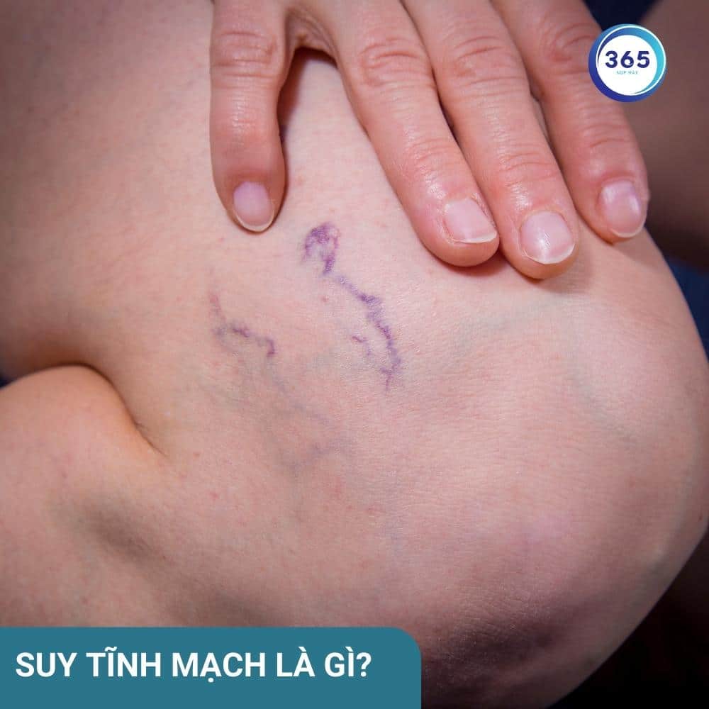 Suy tĩnh mạch là gì? 1 Suy tĩnh mạch là gì