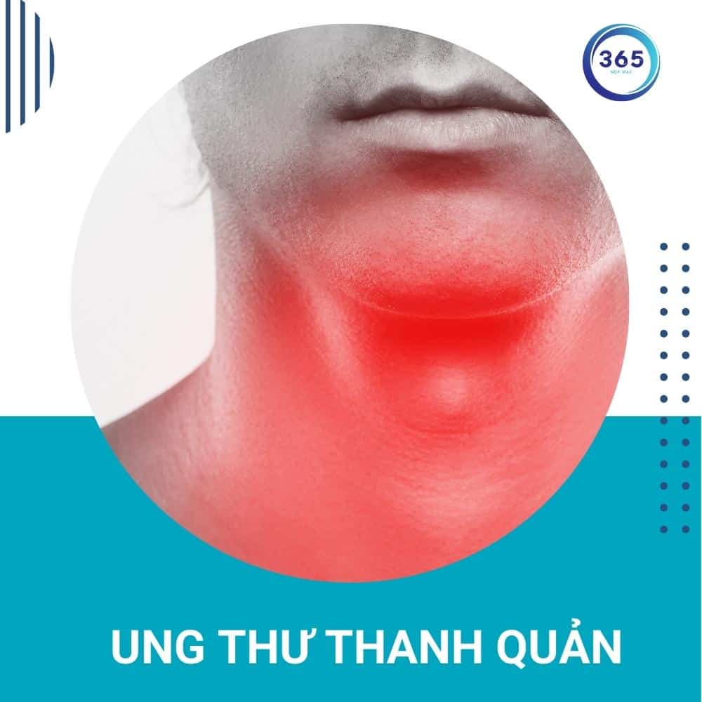 Khàn tiếng kéo dài hãy đi khám 2 khàn tiếng có thể gây ung thư thanh quản