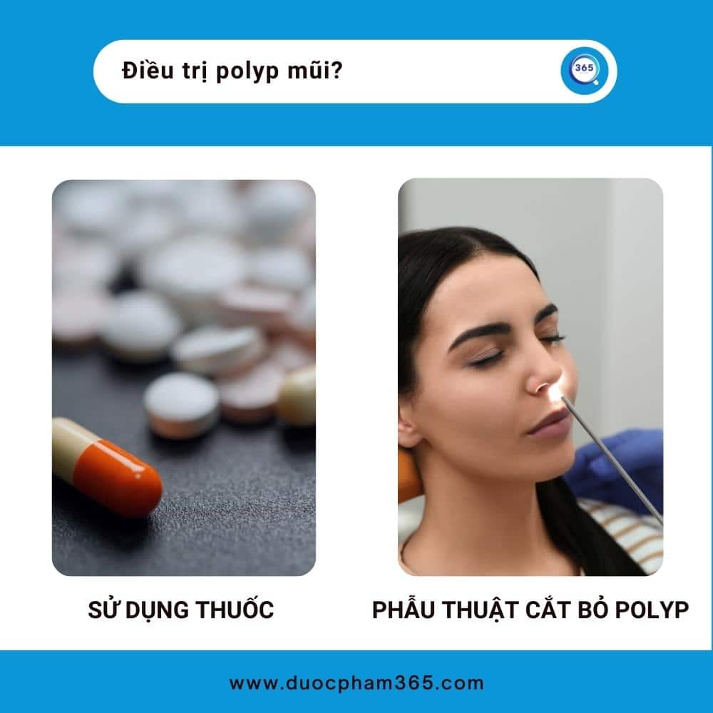 dieu tri polyp mui