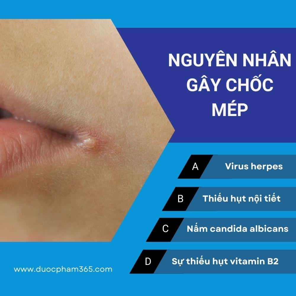 nguyên nhân gây chốc mép