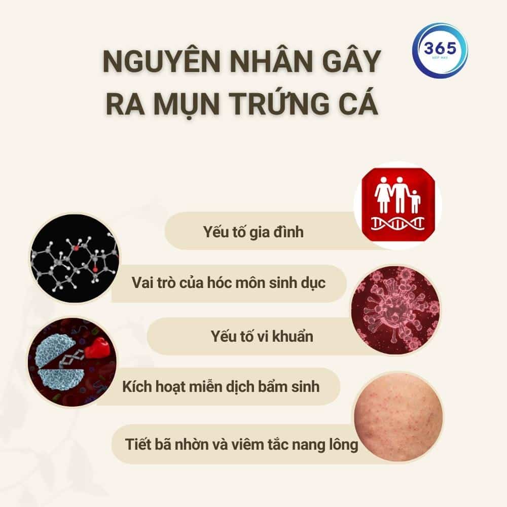 Các nguyên nhân gây mụn trứng cá thường gặp 1 nguyên nhân gây mụn trứng cá