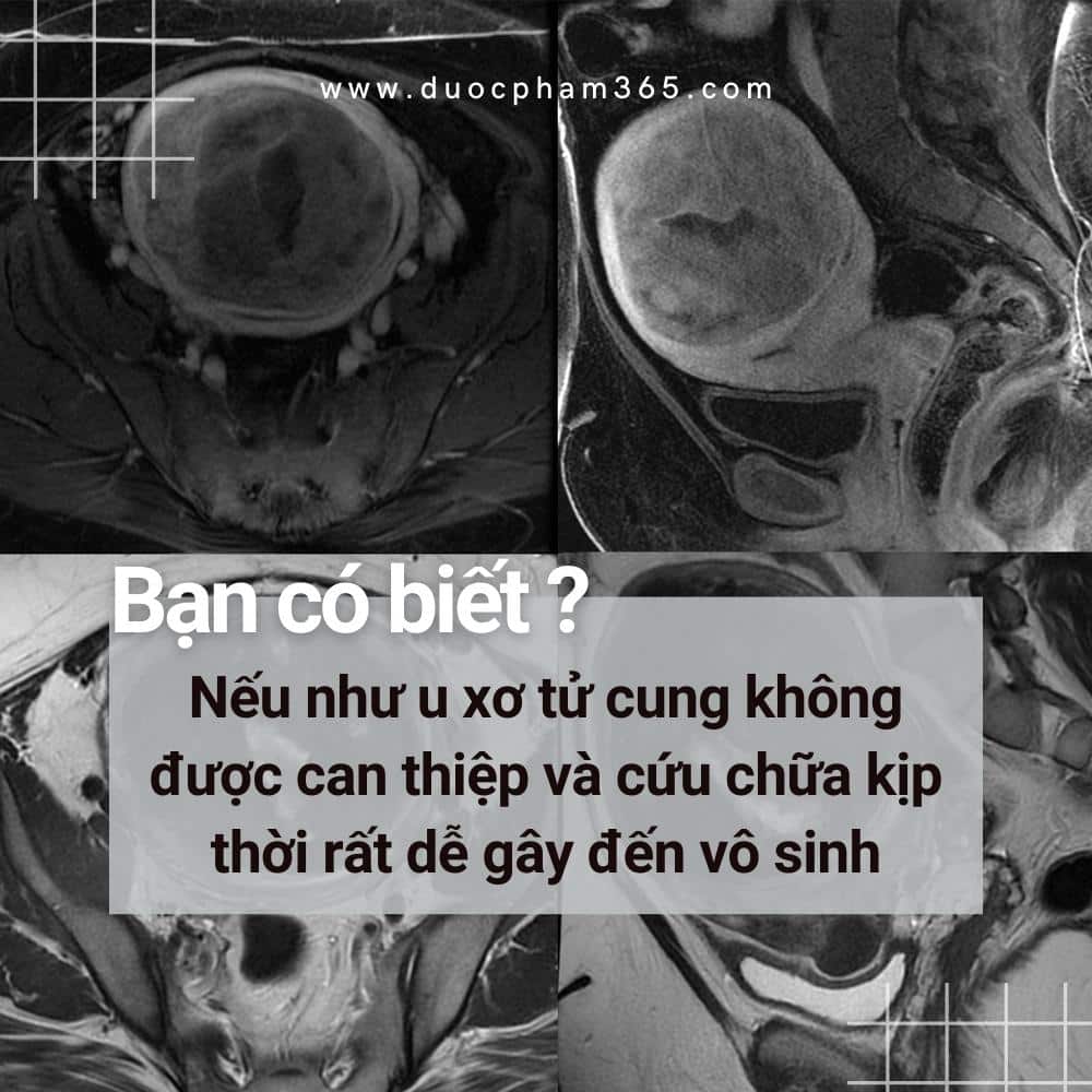 Dấu hiệu nhận biết u xơ tử cung! 1 u xo tu cung dan den vo sinh