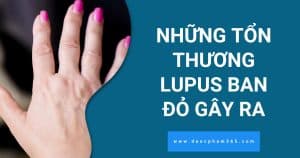 anh bia ton thuong lupus ban do gay ra