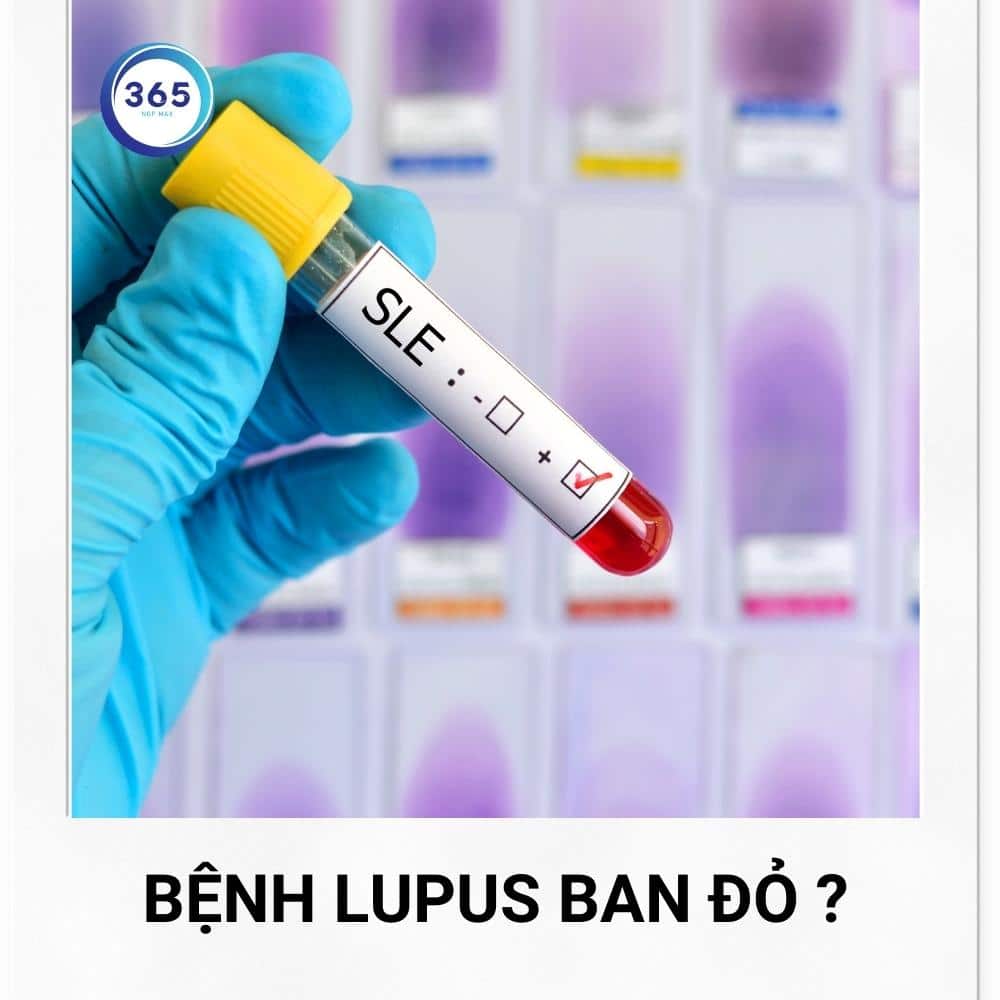 benh lupus ban do