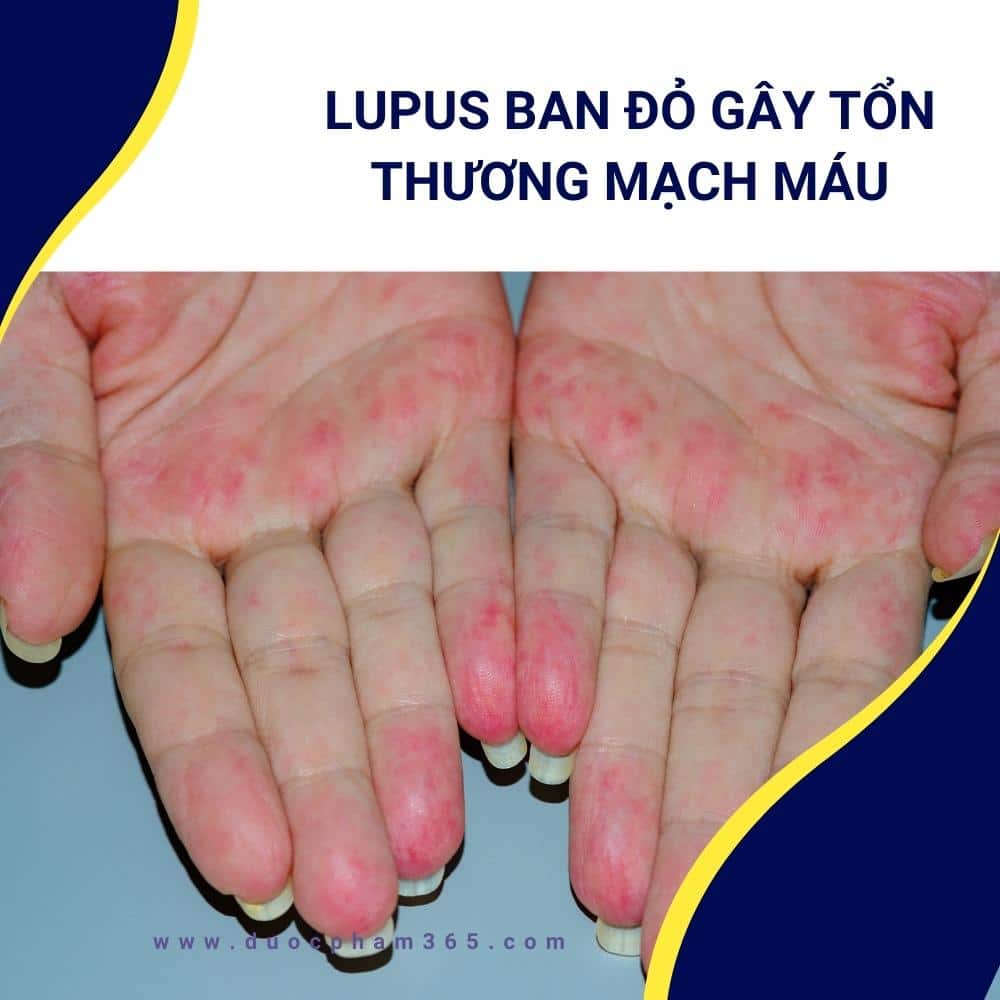lupus ban đỏ gây tổn thương các mạch máu