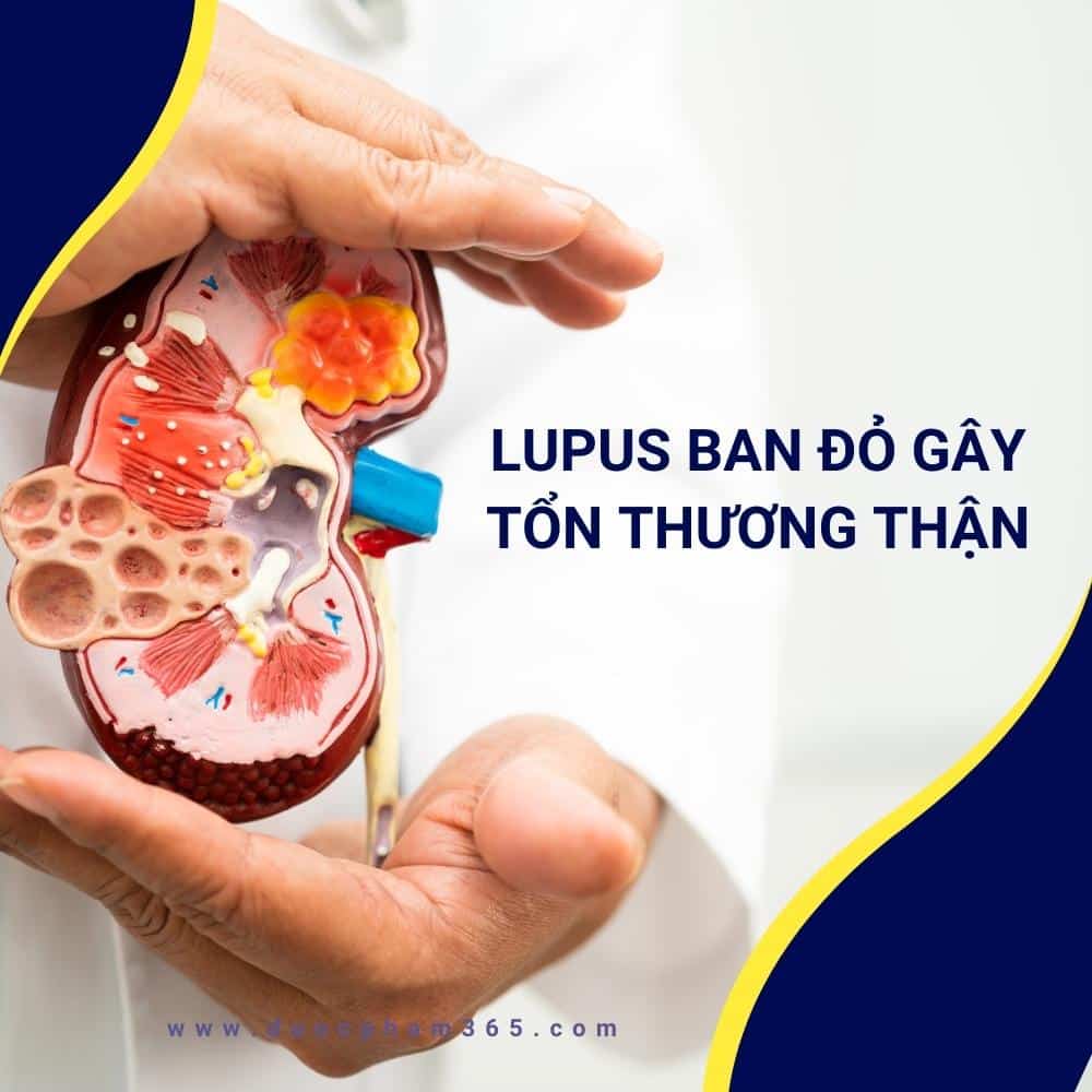 lupus ban do gay ton thuong than