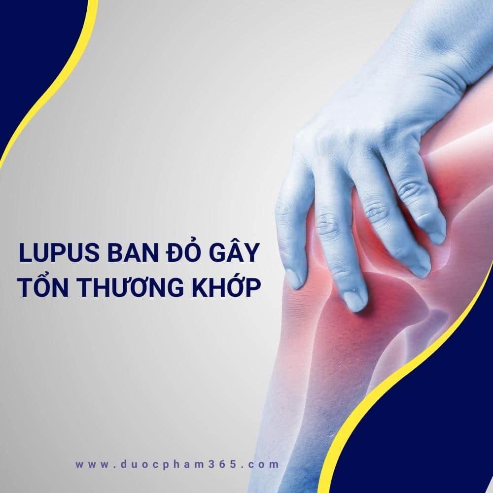 lupus ban do gay ton thuong tim khop