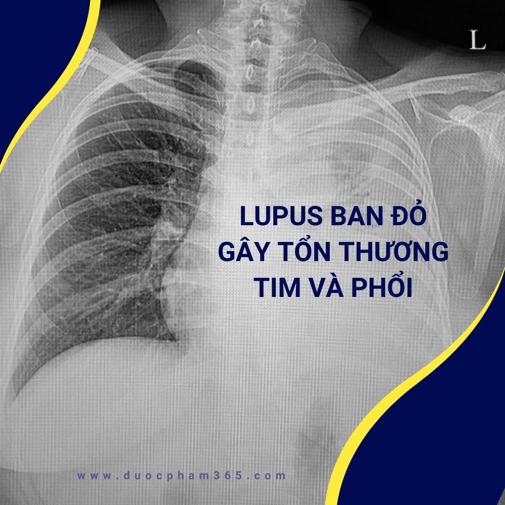 lupus ban do gay ton thuong tim phoi