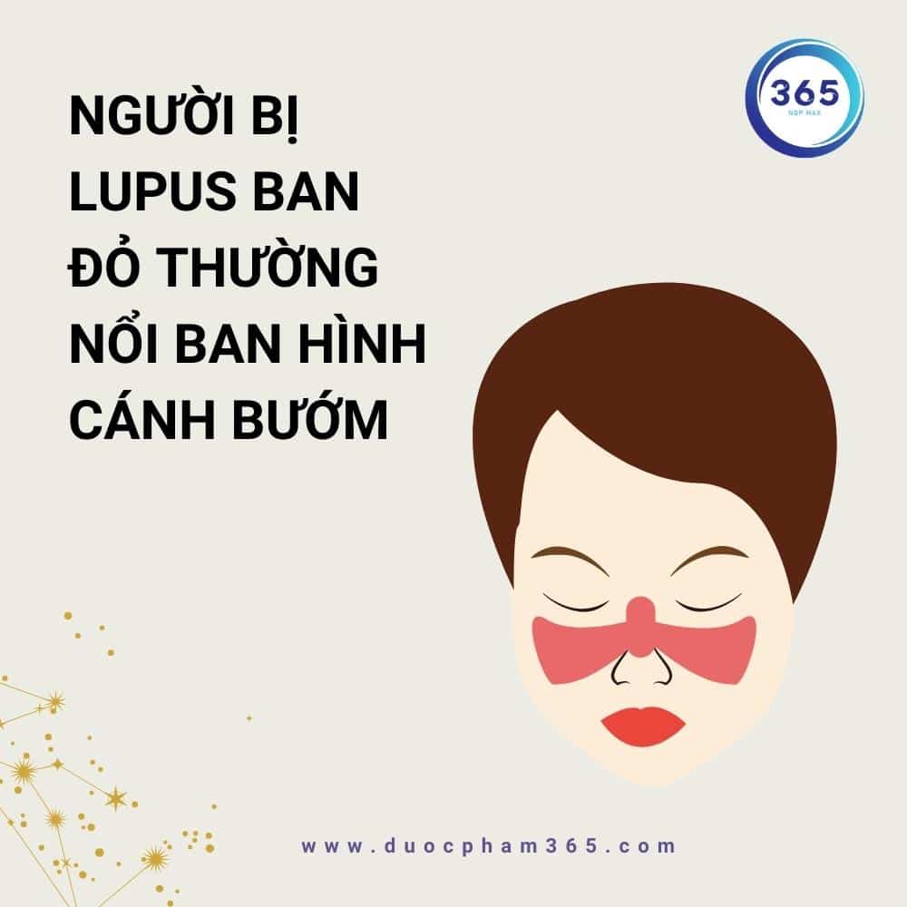lupus ban do thuong noi ban hinh canh buom