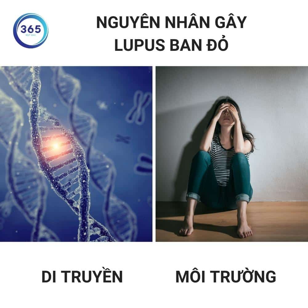 nguyên nhân gây lupus ban đỏ