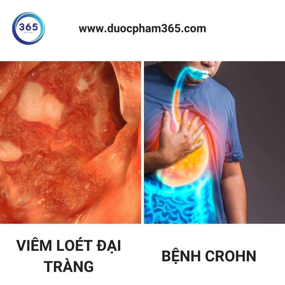 Viêm đường ruột là gì? 1 viem duong ruot la gi