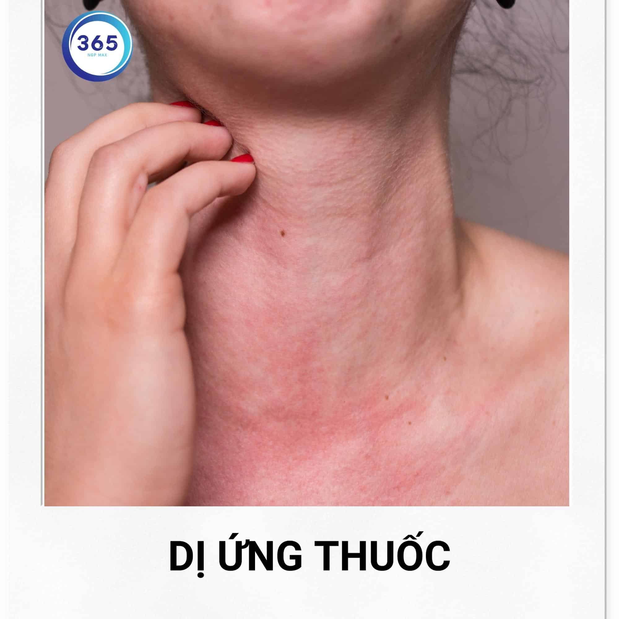 benh tri gay ngua hau mon 2