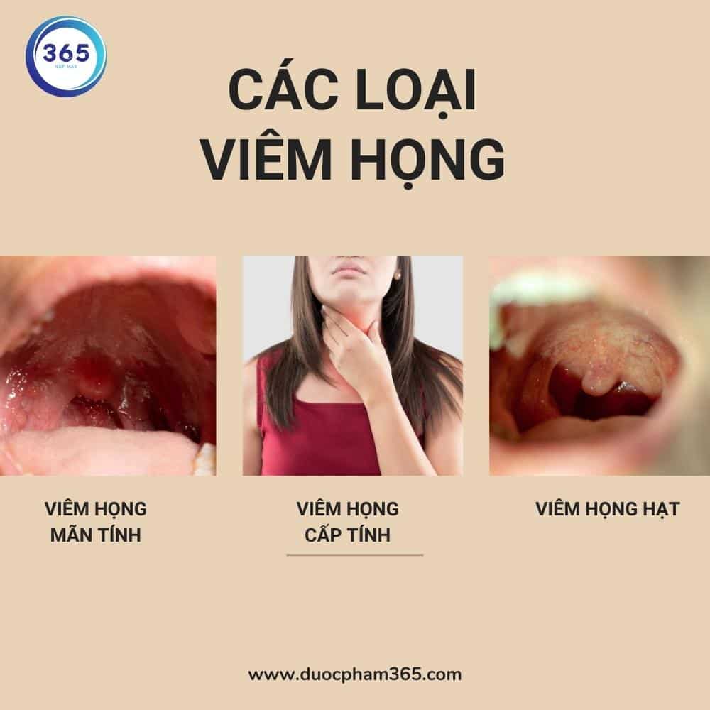 Viêm họng: Những điều cần biết! 1 Các loại viêm họng