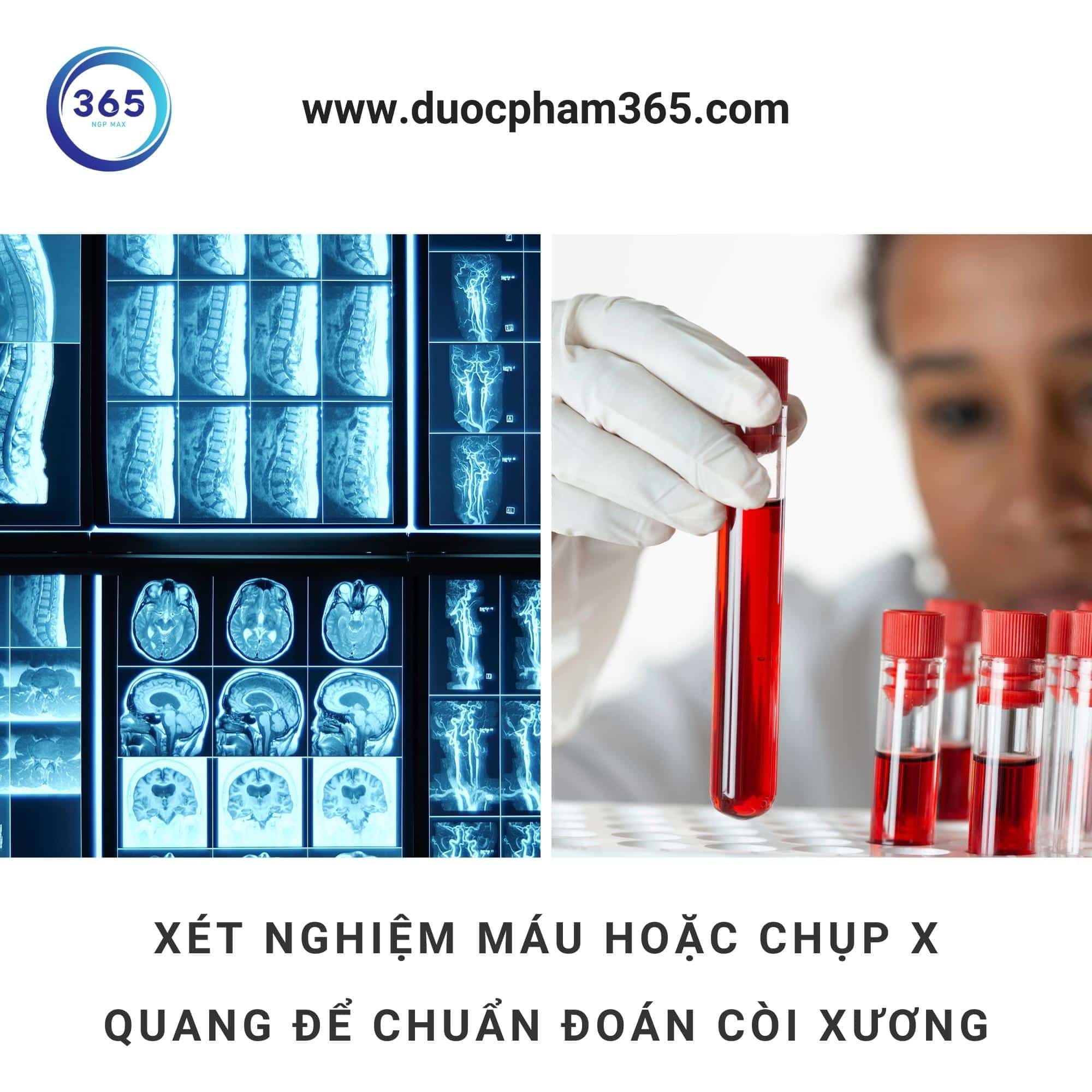 Bệnh còi xương: Nguyên nhân, triệu chứng ở đâu? 4 chuan doan coi
