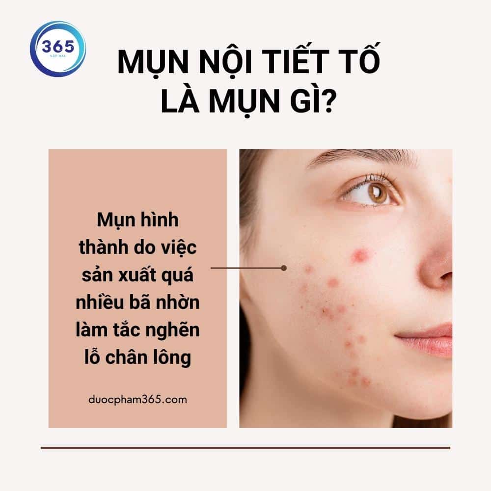 Mụn nội tiết tố