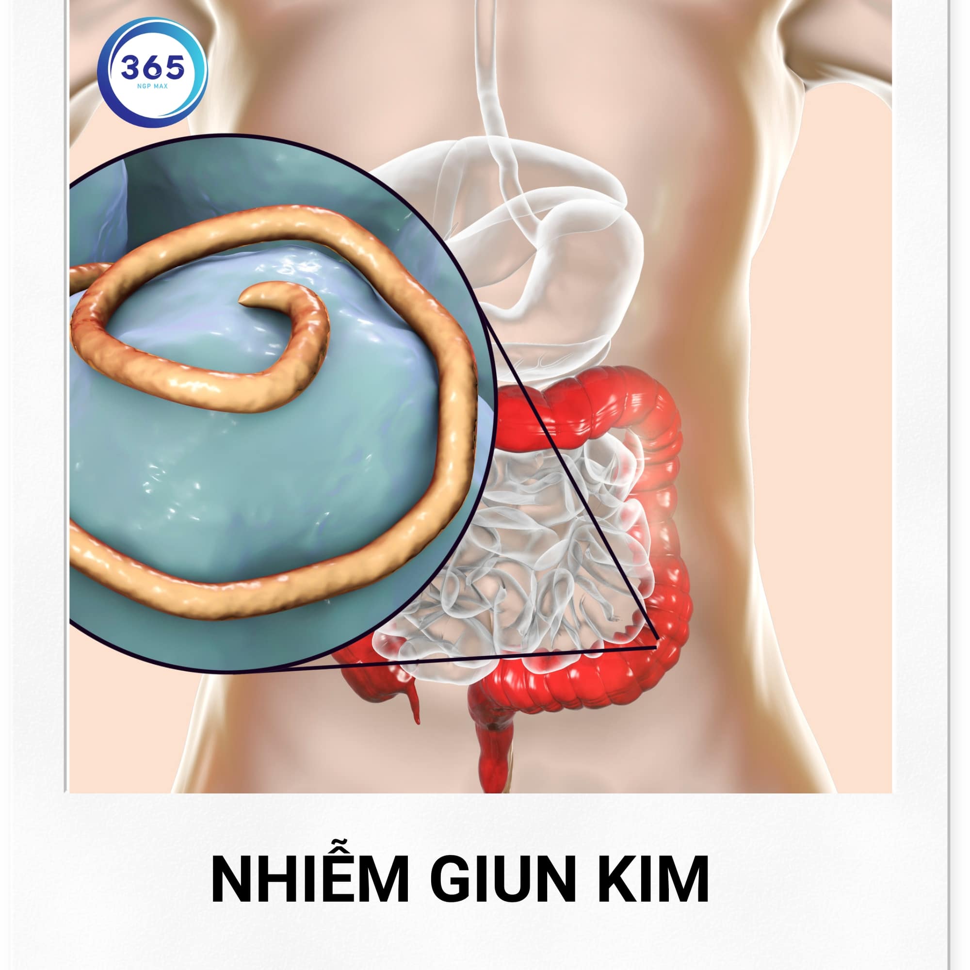 Nhiễm giun kim gây ngứa hậu môn