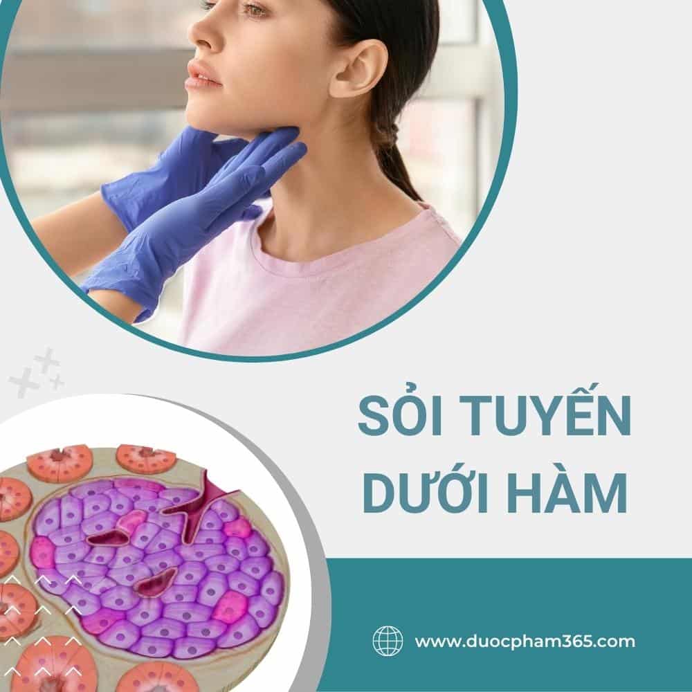 Sỏi tuyến nước bọt là gì? 2 soi tuyen nuoc bot duoi ham