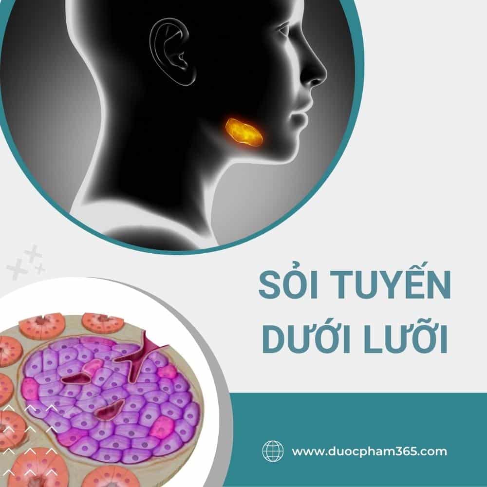 Sỏi tuyến nước bọt là gì? 3 Sỏi tuyến nước bọt ở dưới lưỡi
