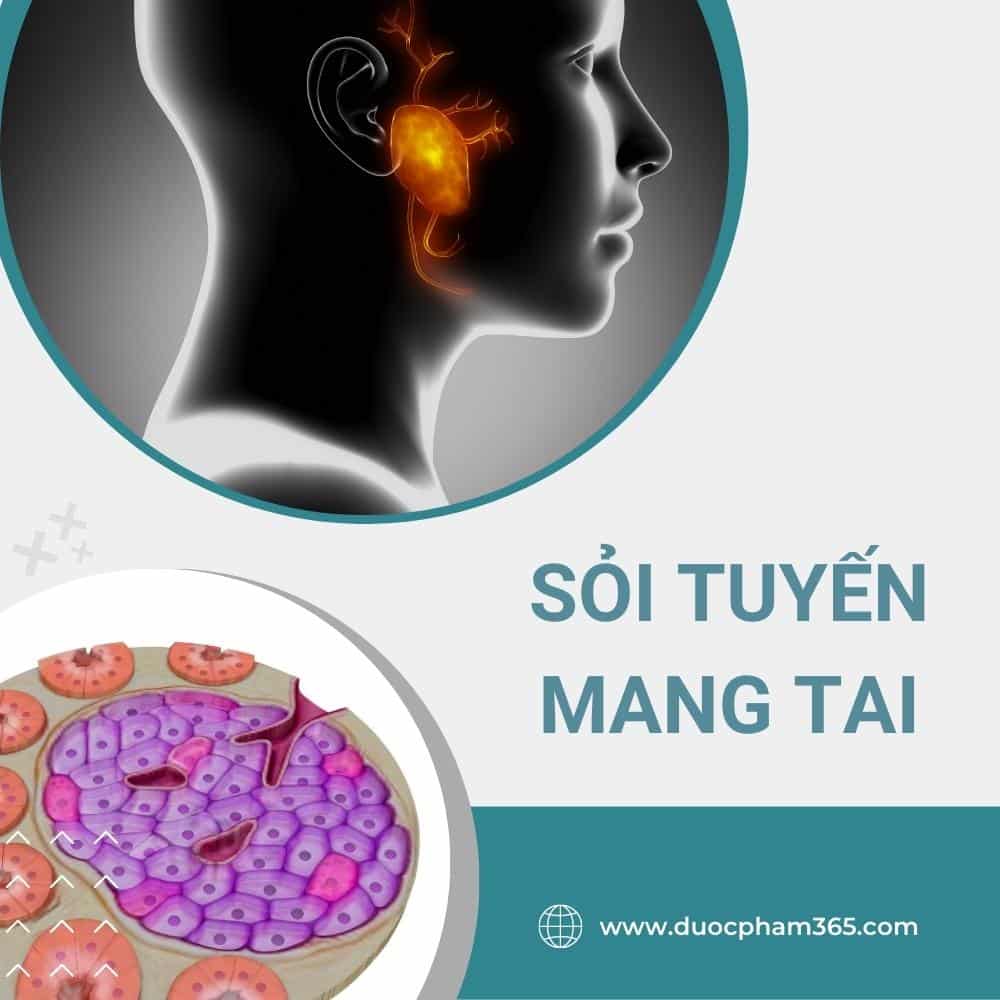 Sỏi tuyến nước bọt là gì? 1 soi tuyen nuoc bot mang tai
