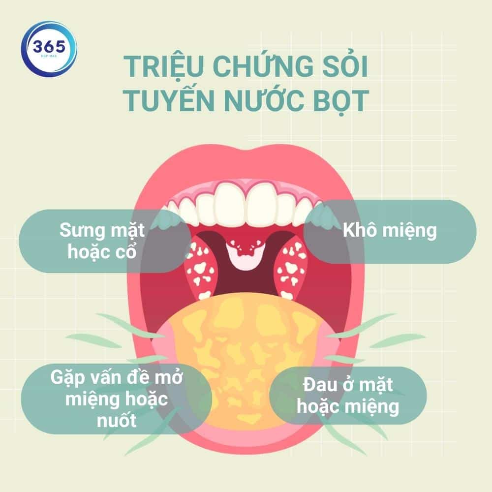 Sỏi tuyến nước bọt là gì? 4 trieu chung soi tuyen nuoc bot