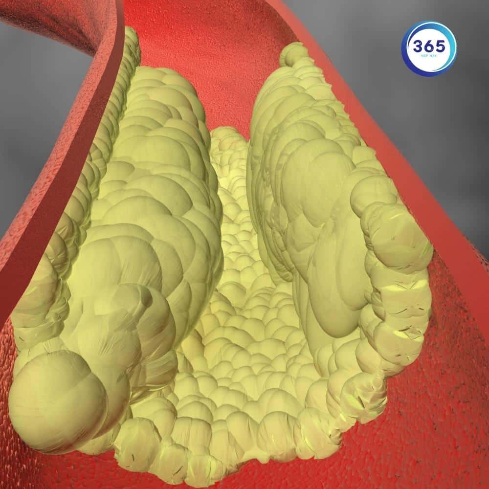 Hút thuốc lá gây ảnh hưởng gì đến tim mạch 1 xơ vữa động mạch do hút thuốc lá